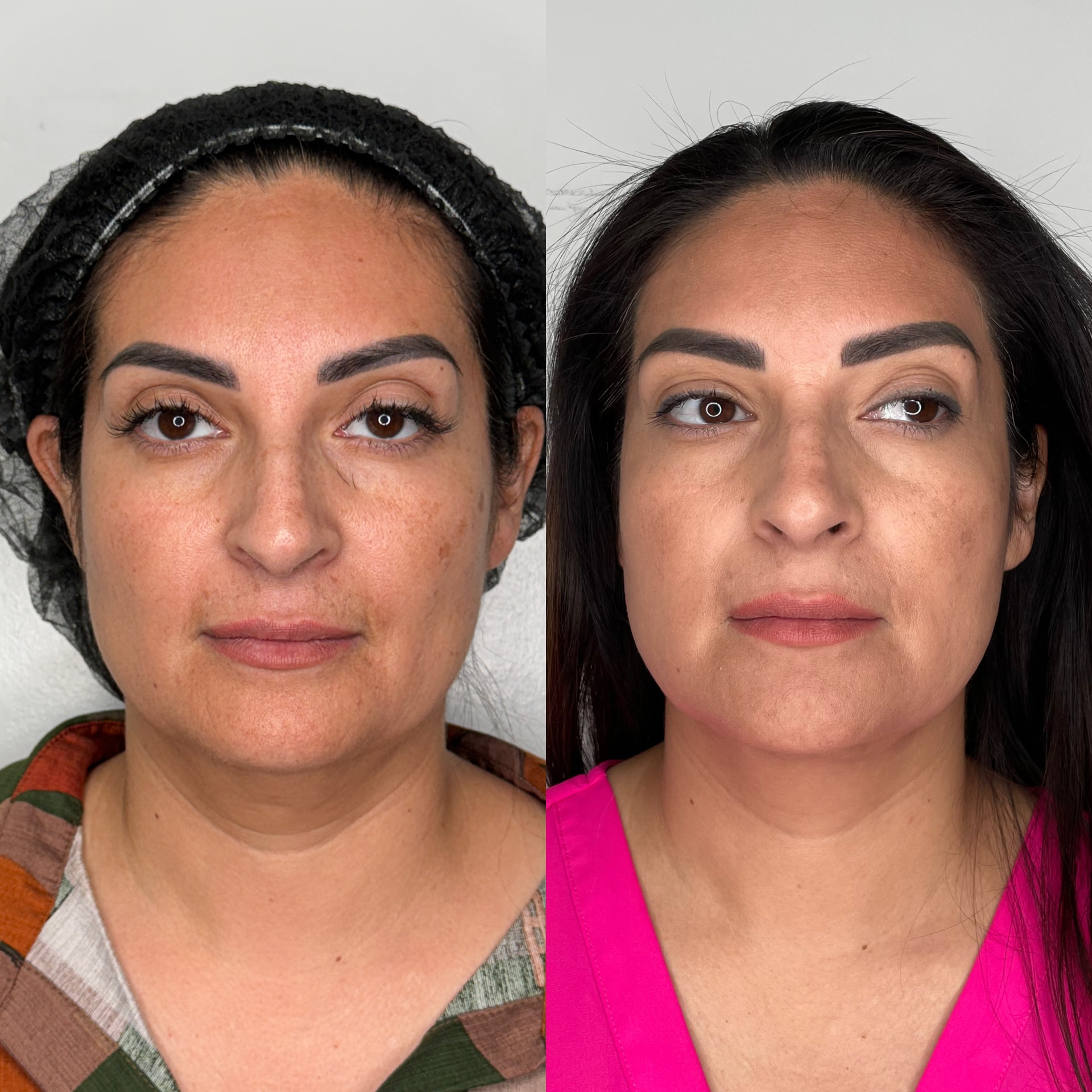 Chin Liposuction patient result — before (left) and after (right)