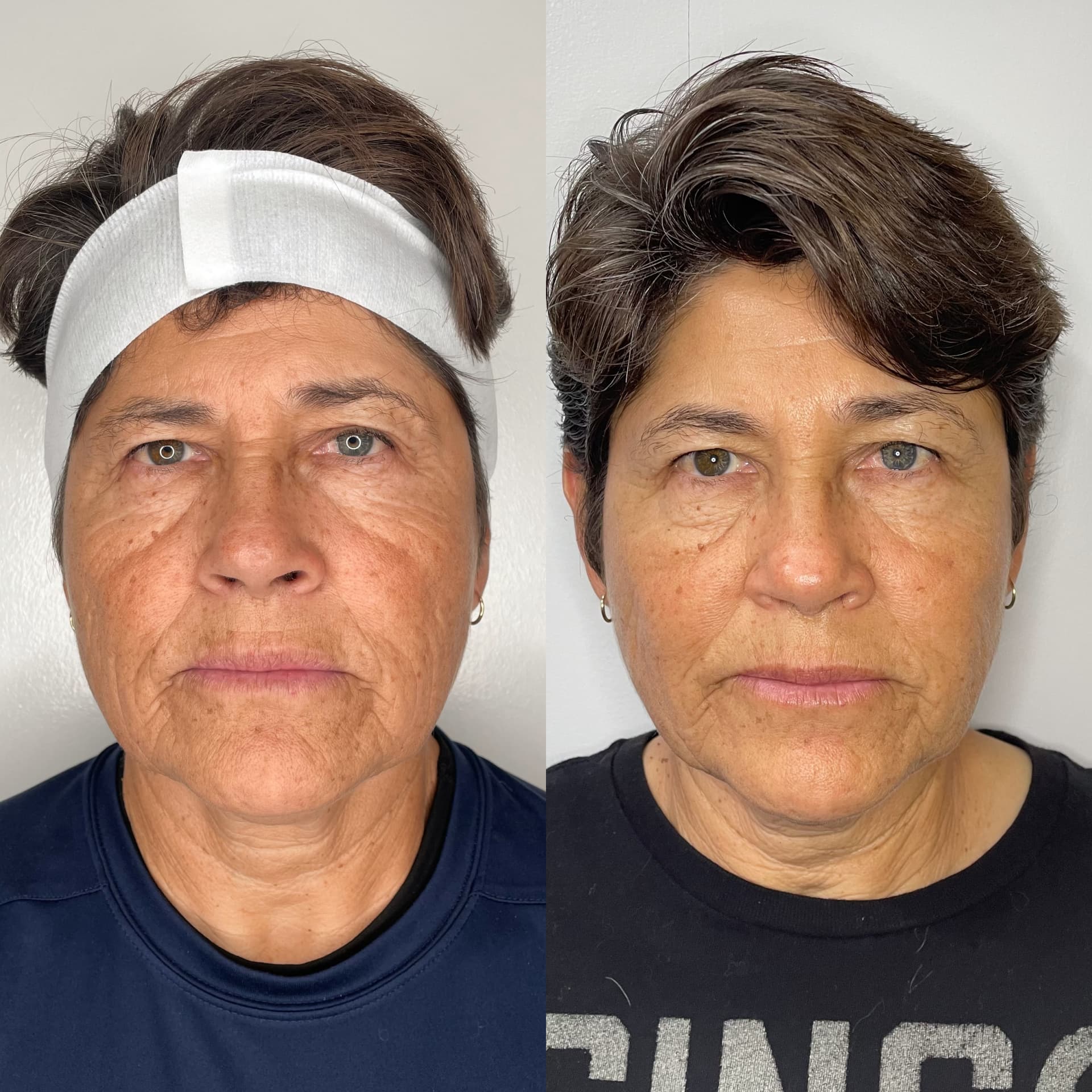 EndoLift patient result — before (left) and after (right)
