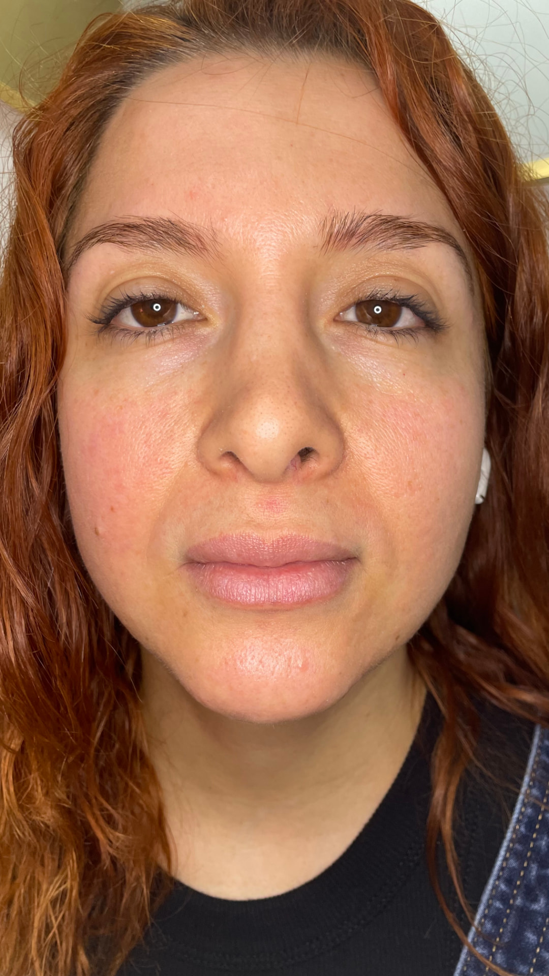 Lip Filler result — before