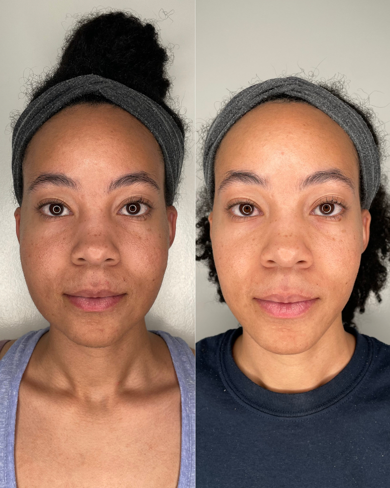 EndoLift patient result — before (left) and after (right)