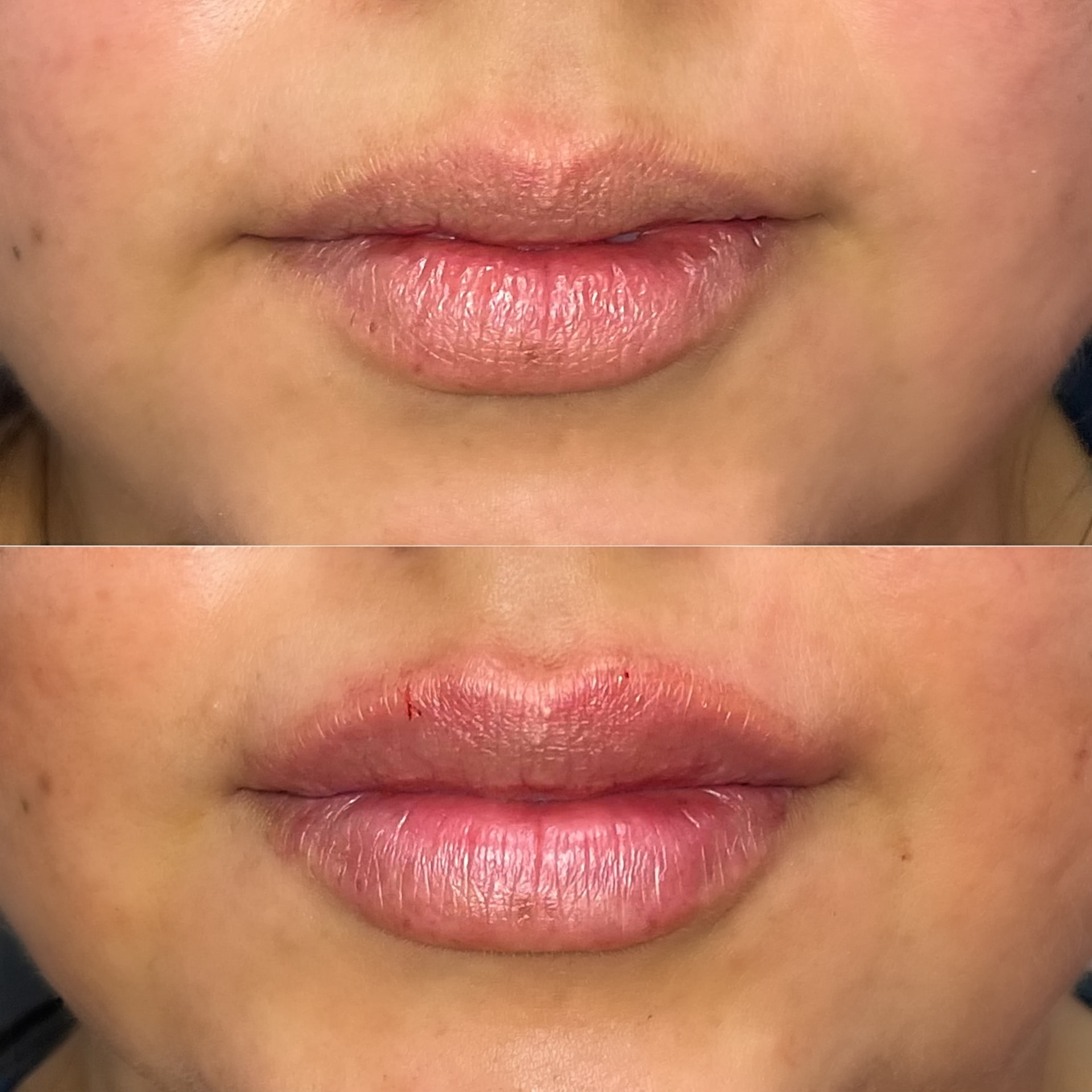 Lip filler patient result — before (top) and after (bottom)
