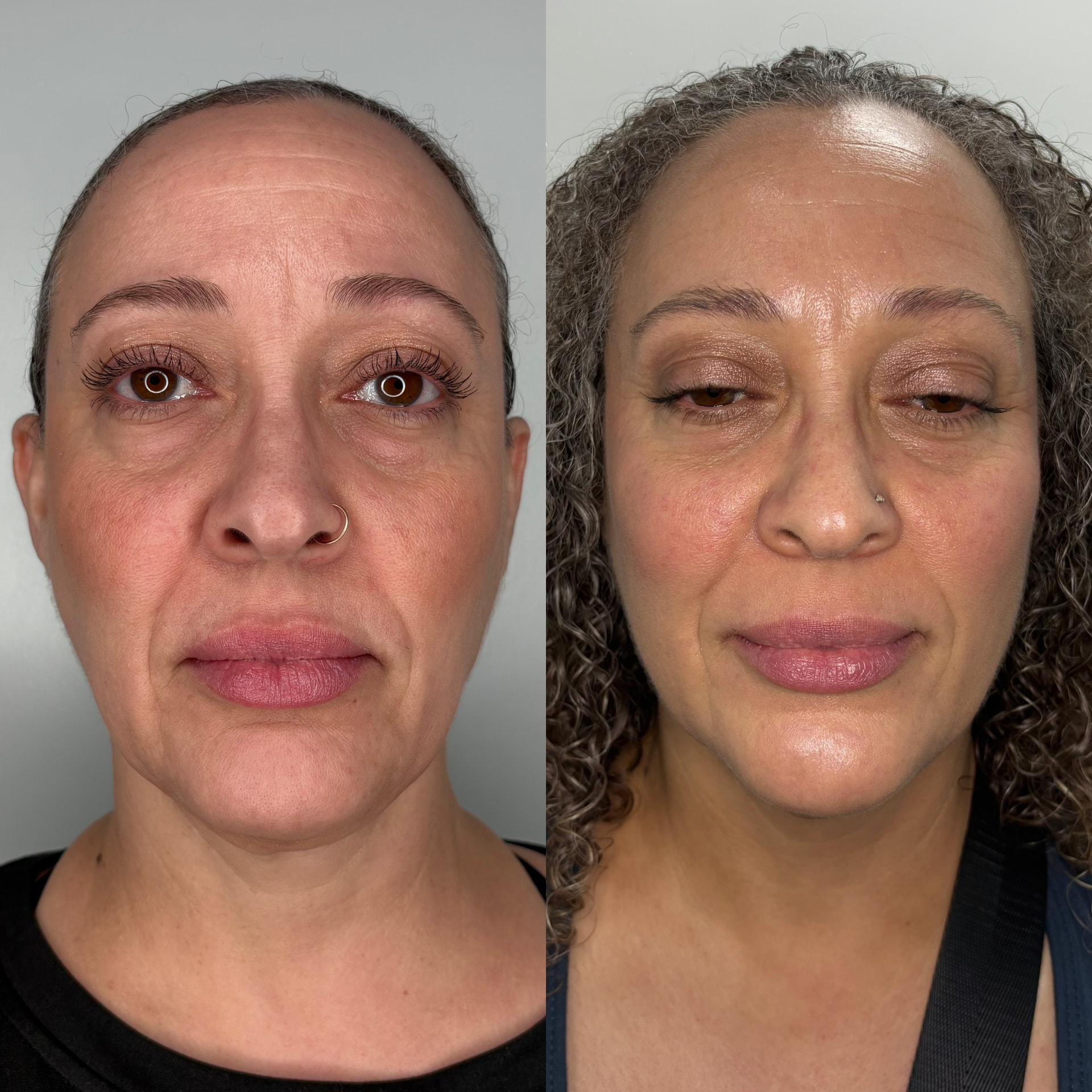 Chin Liposuction and EndoLift combination patient result — before (left) and after (right)