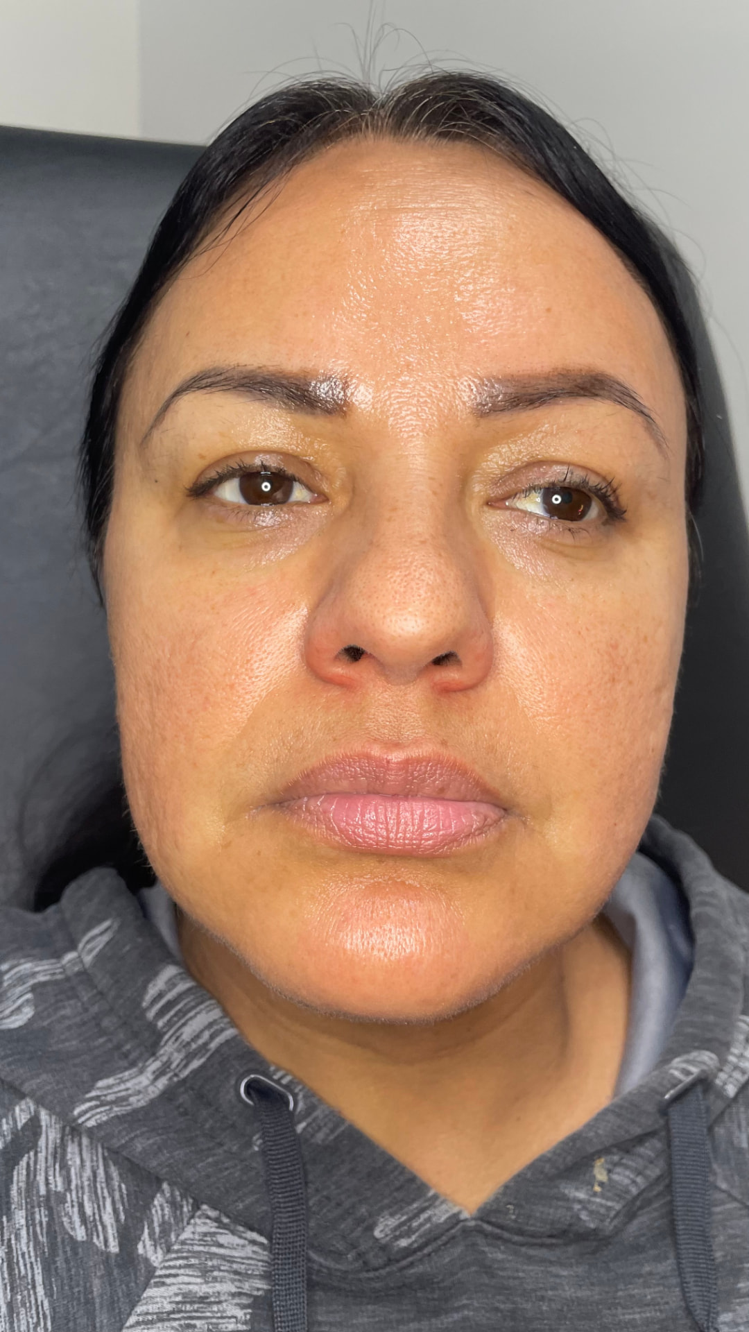Lip filler patient result — before and after — before