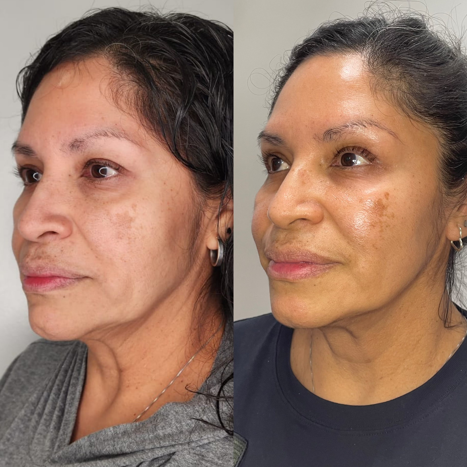 EndoLift patient result — before (left) and after (right)
