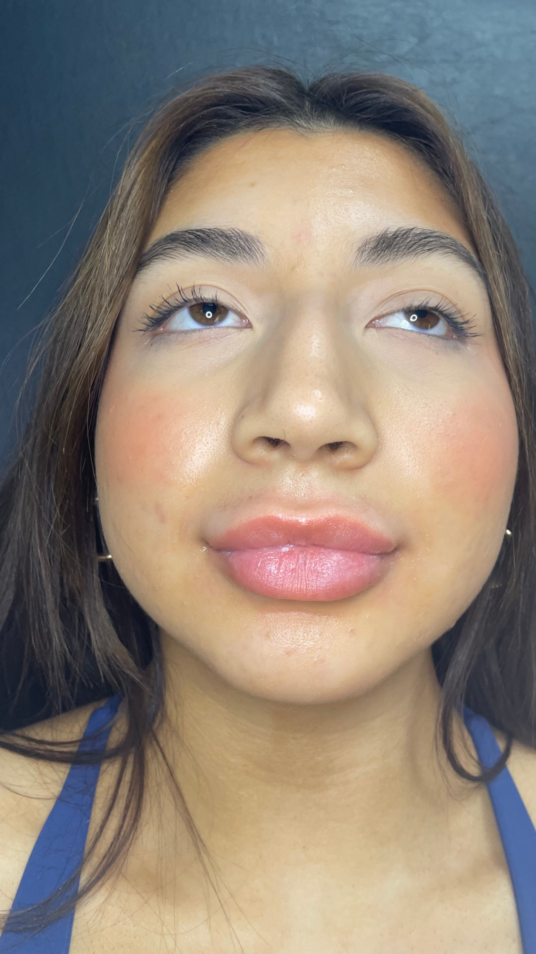 Lip filler patient result — before and after — before