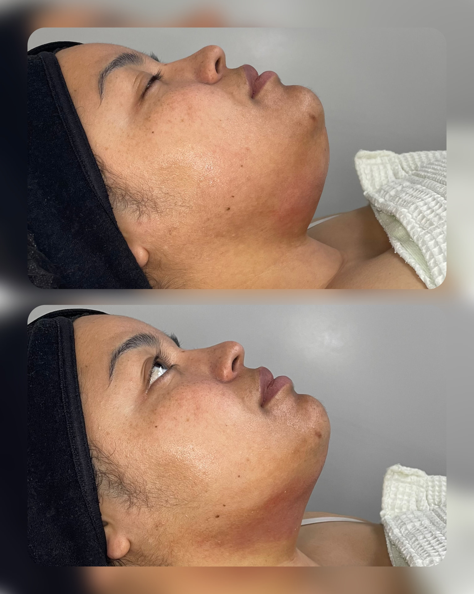 Chin Liposuction patient result — before (top) and after (bottom)