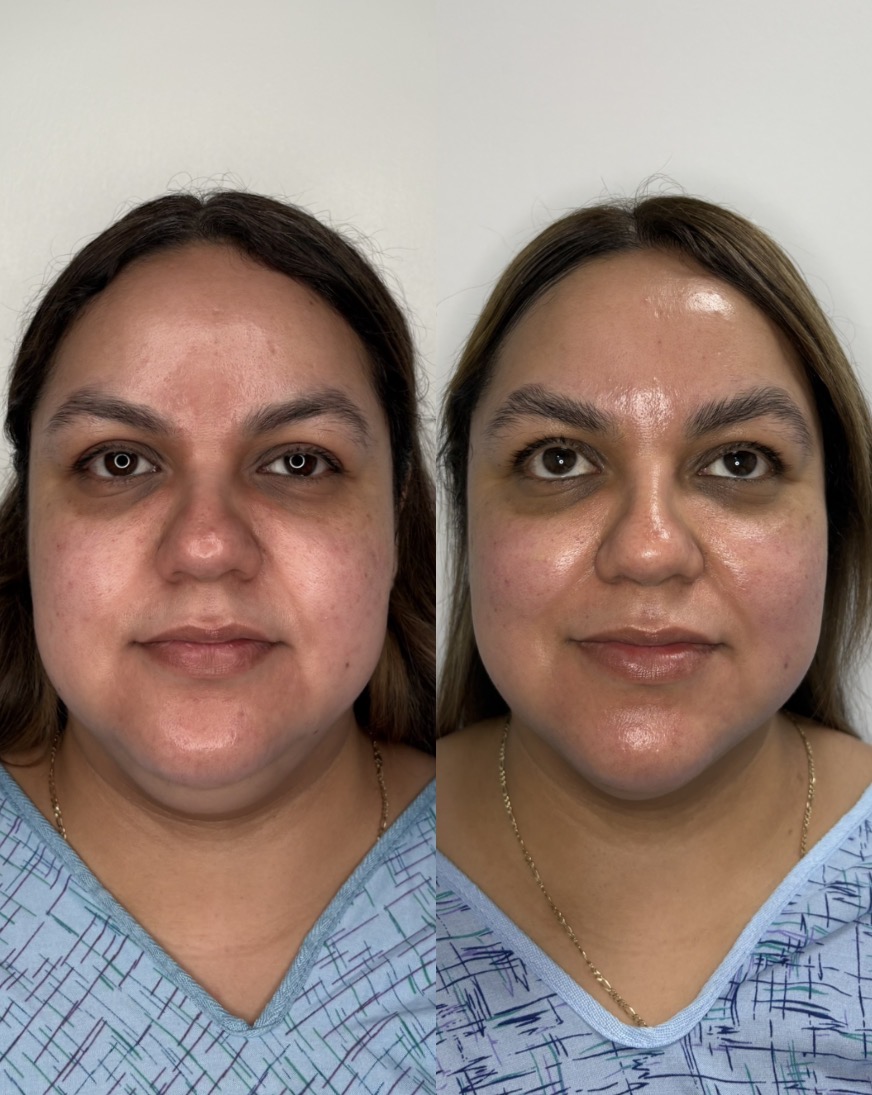 Chin Liposuction and EndoLift combination patient result — before (left) and after (right)