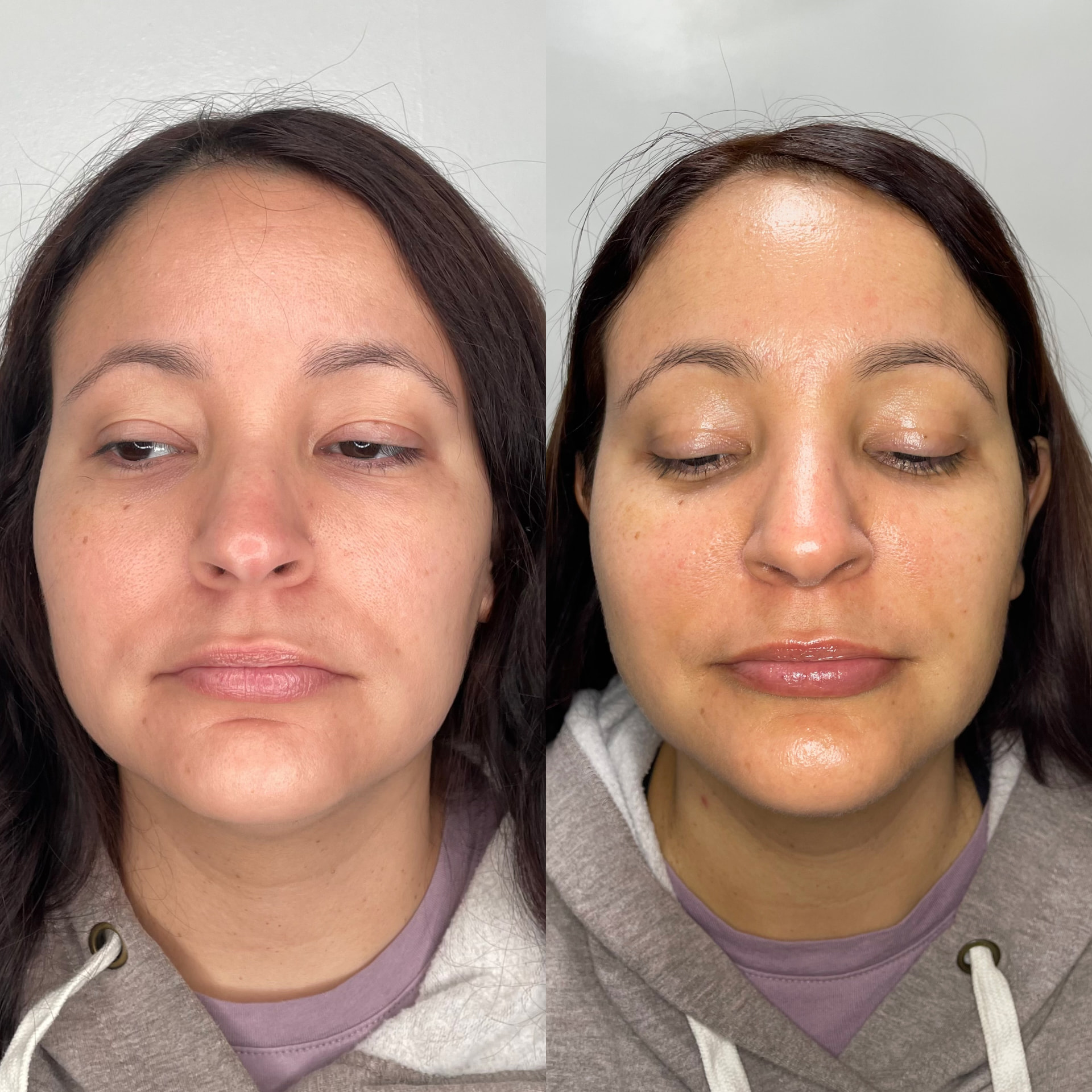 EndoLift patient result — before (left) and after (right)