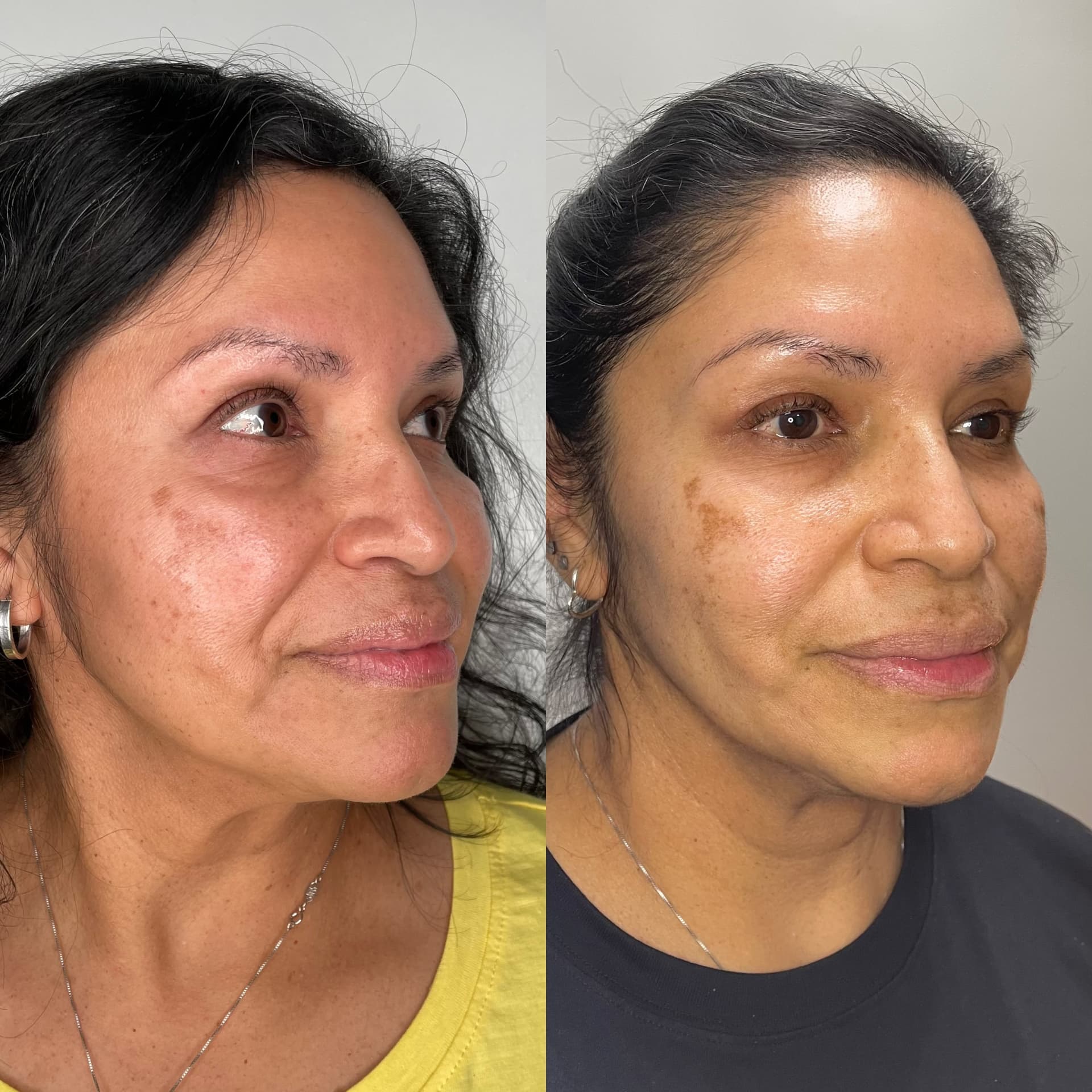 EndoLift patient result — before (left) and after (right)