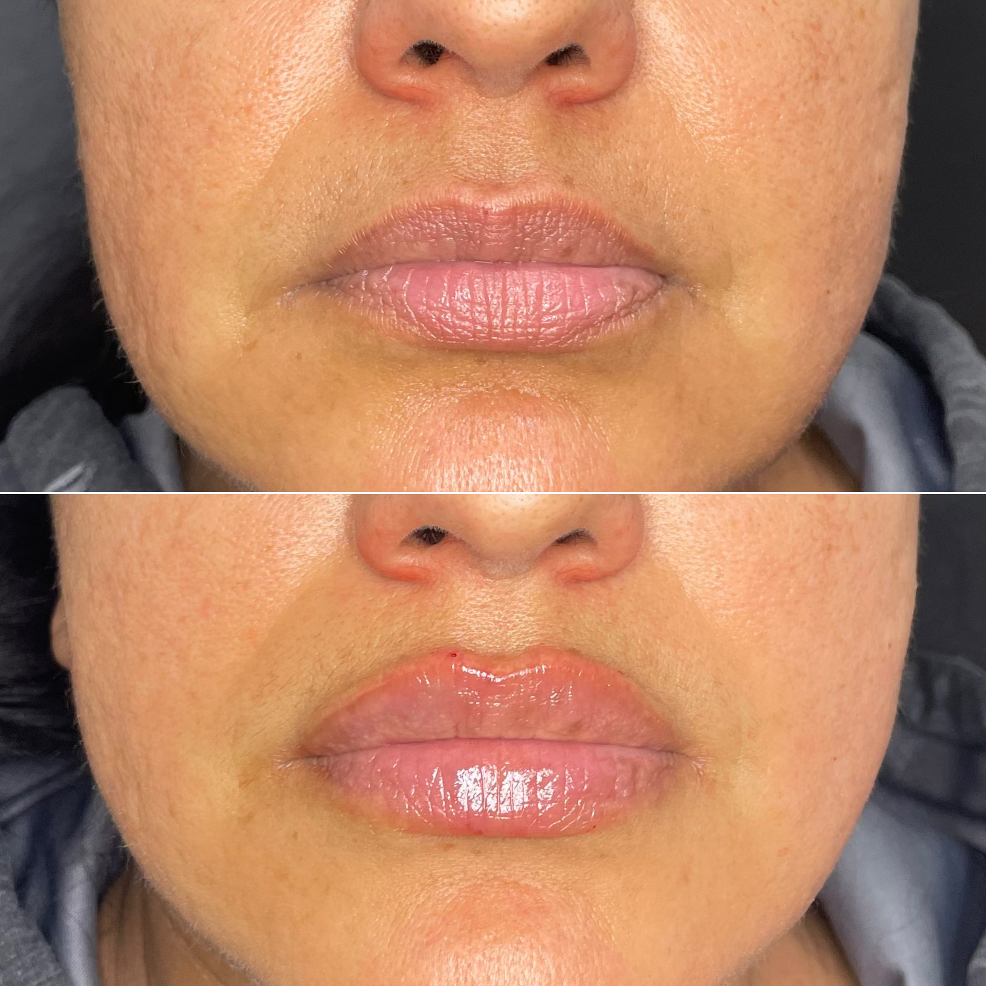Lip filler patient result — before (top) and after (bottom)