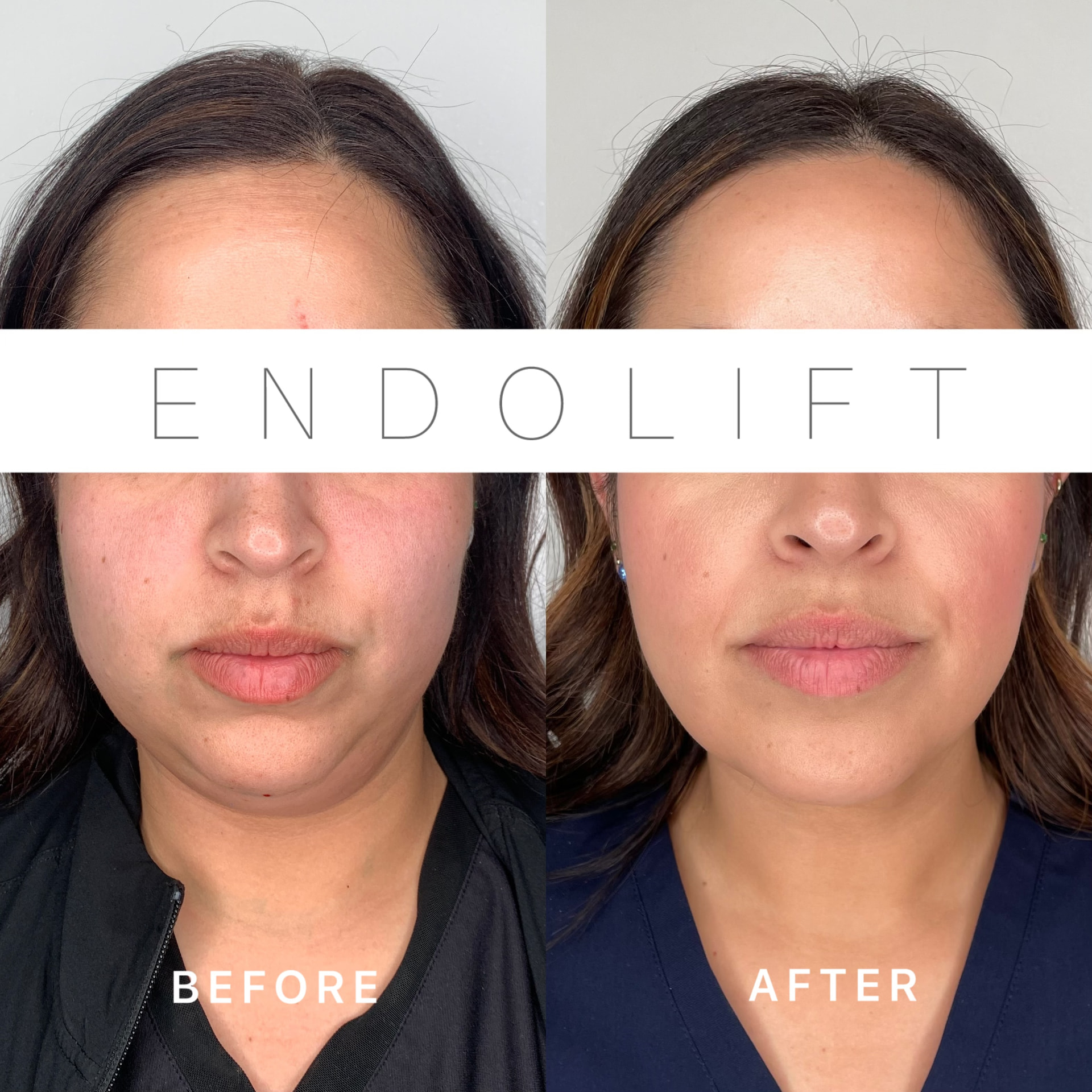 EndoLift patient result — before (left) and after (right)