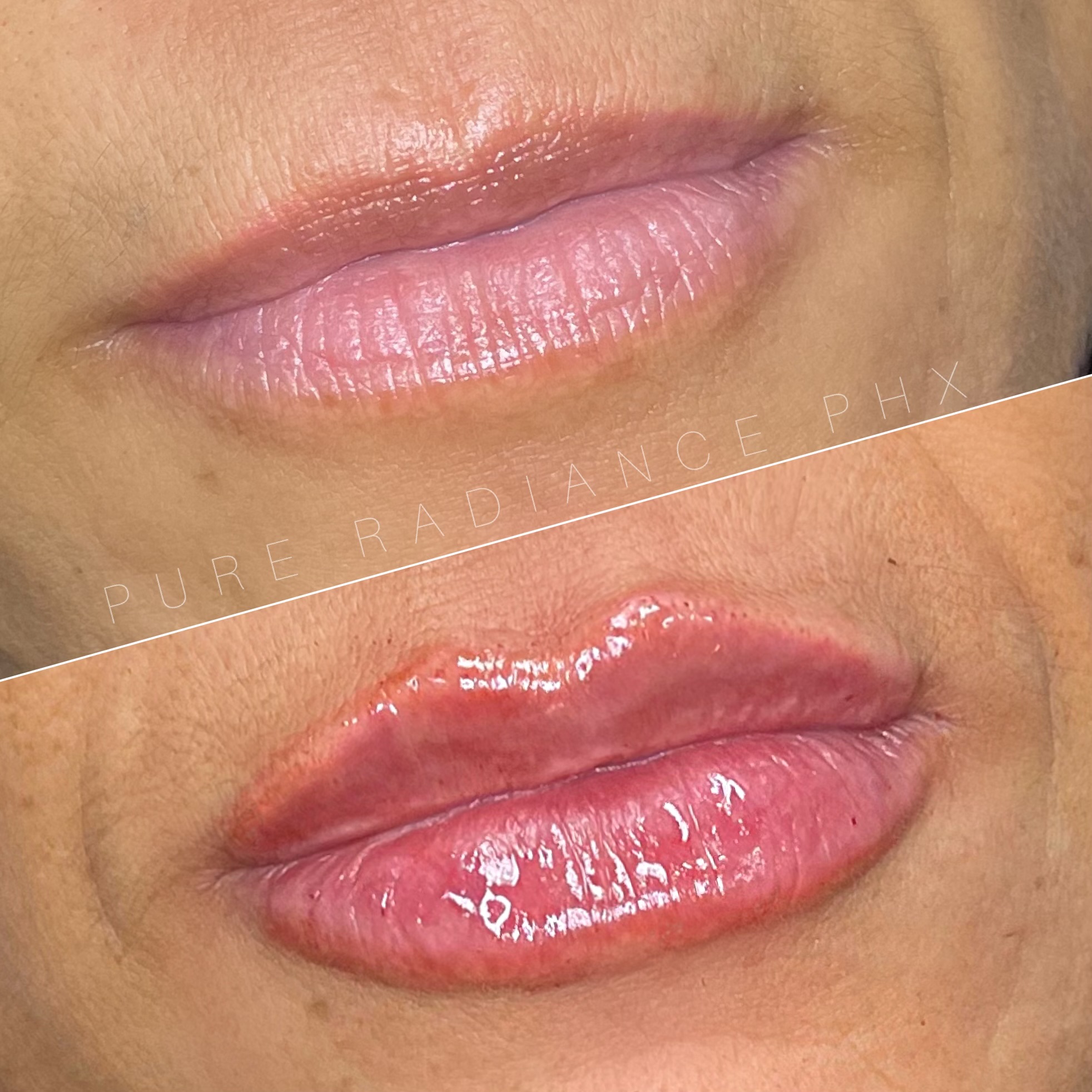 Lip filler patient result — before (top) and after (bottom)