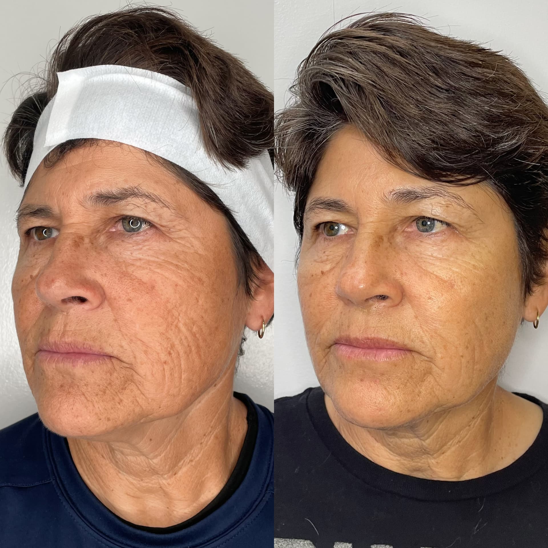 EndoLift patient result — before (left) and after (right)