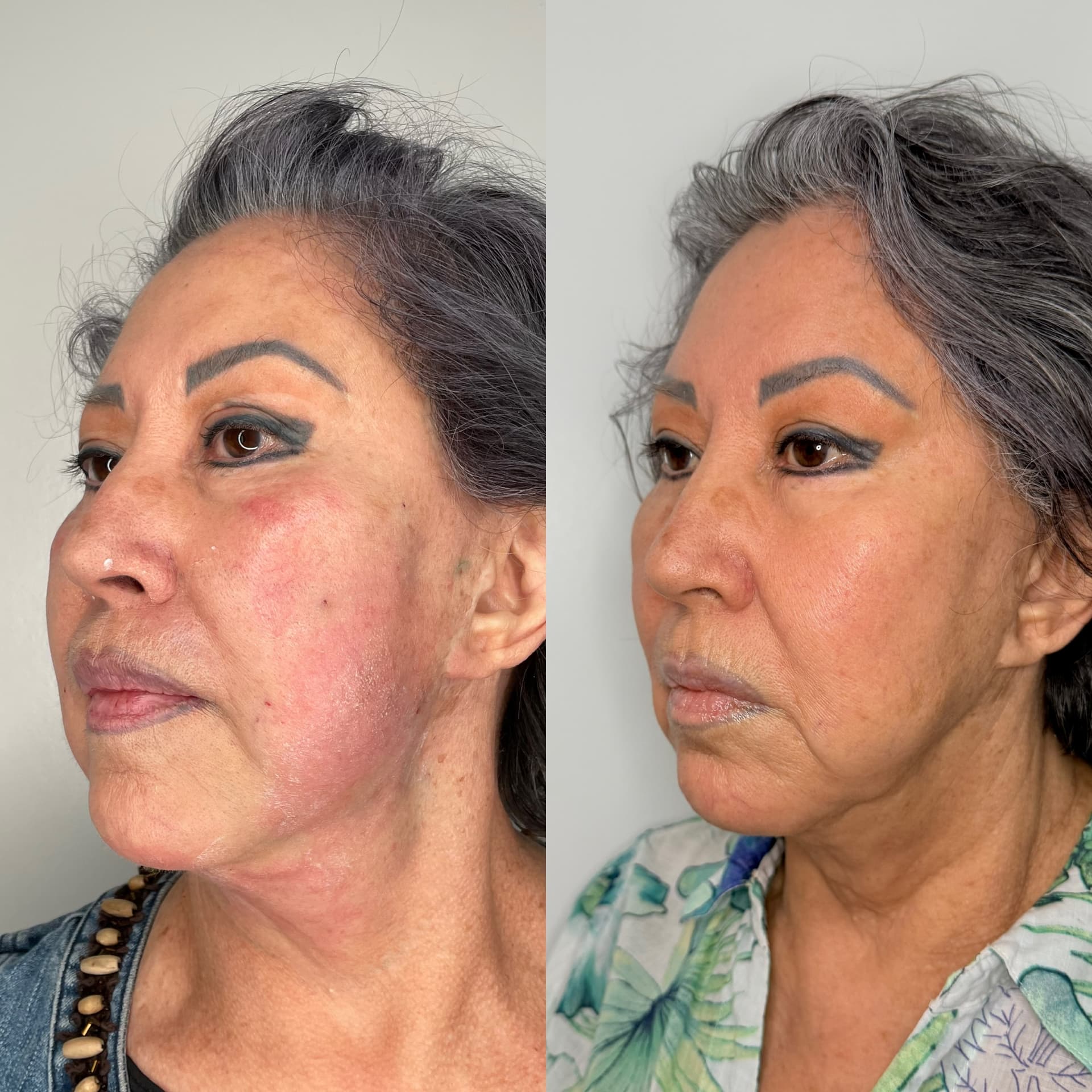 EndoLift patient result — before (left) and after (right)