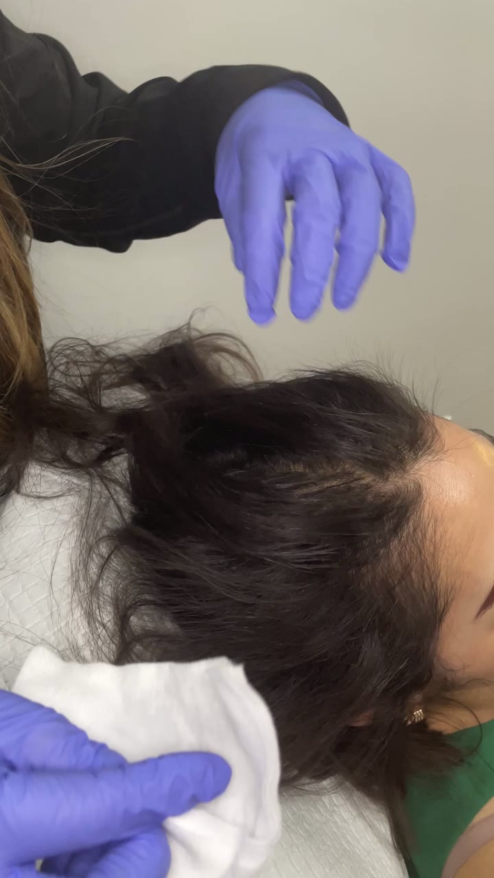 Microneedling treatment at Pure Radiance — clip 2