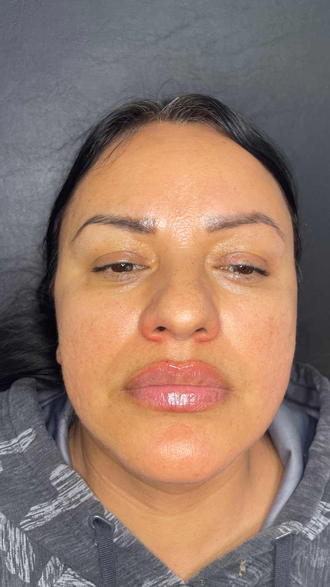 Lip filler patient result — before and after — after