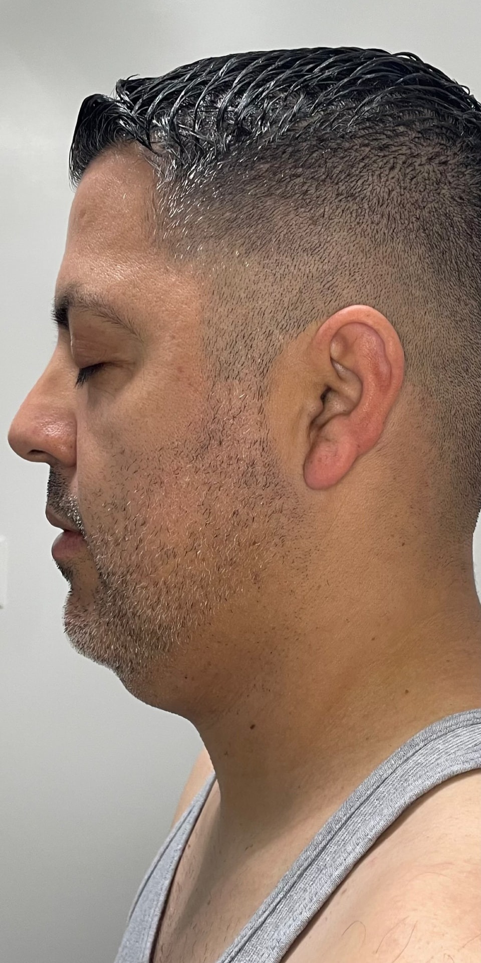 Chin Liposuction result — before