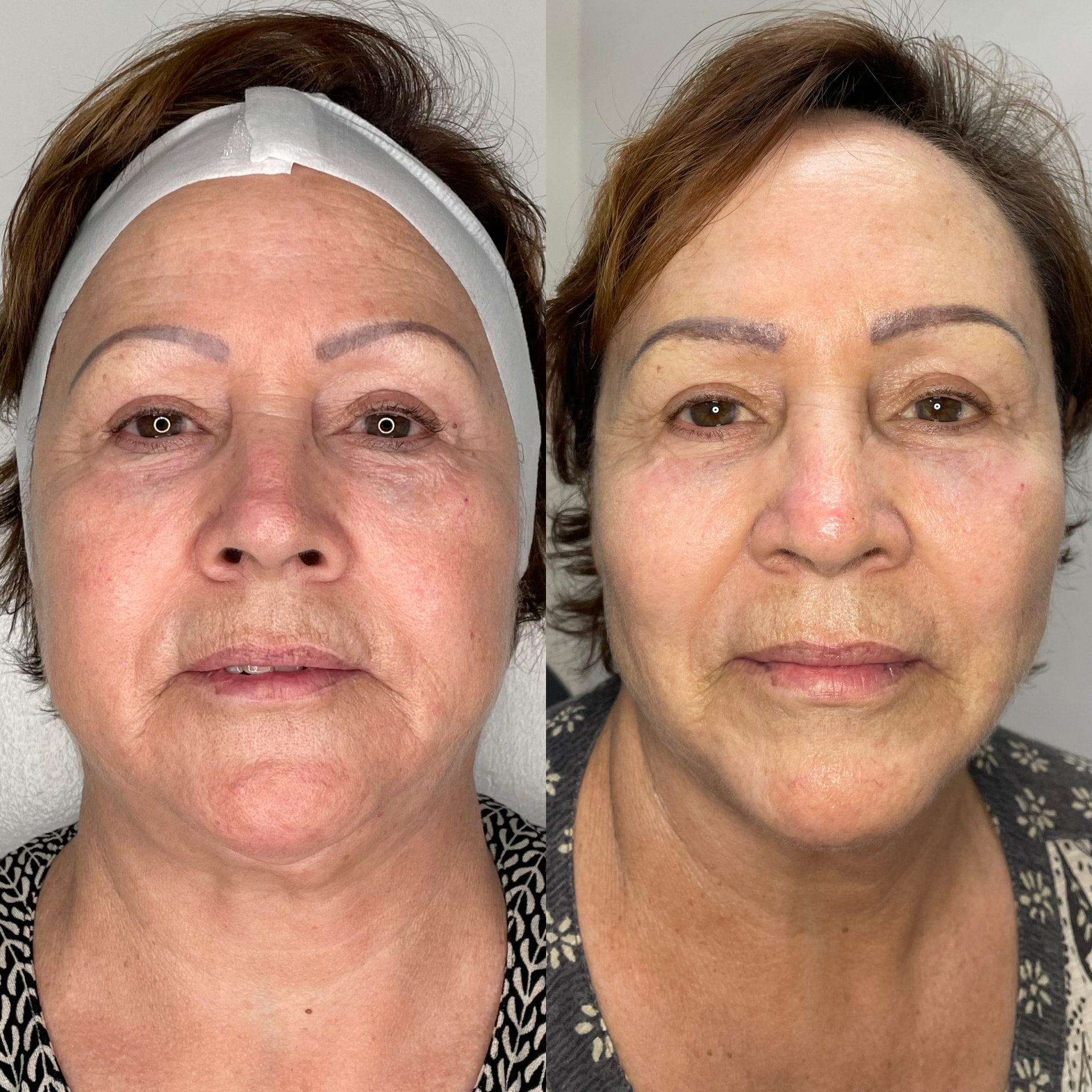 EndoLift patient result — before (left) and after (right)
