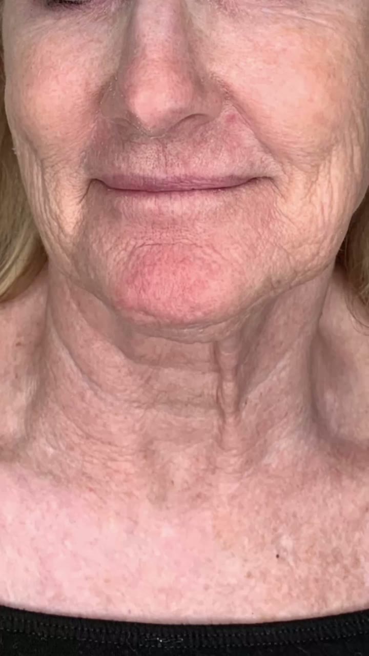 EndoLift patient footage — close-up views of the jawline, neck and décolletage showing skin tone and texture