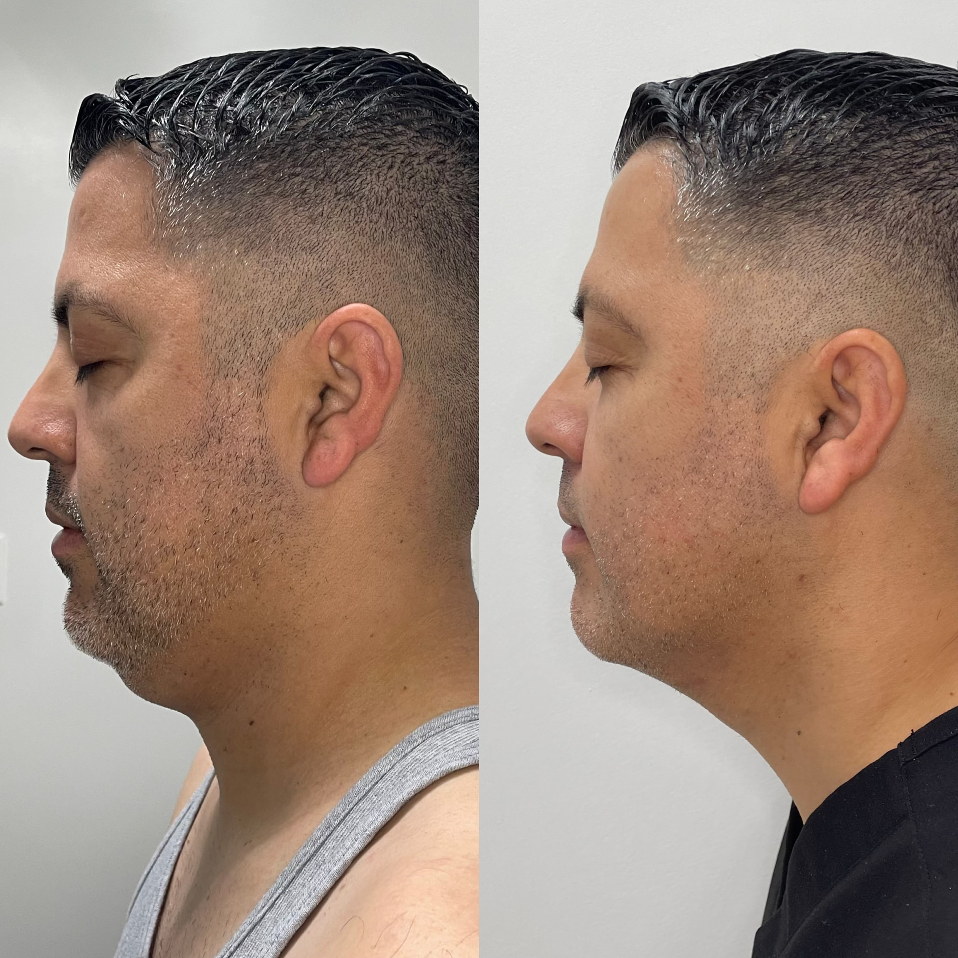 Chin Liposuction patient result — before (left) and after (right)