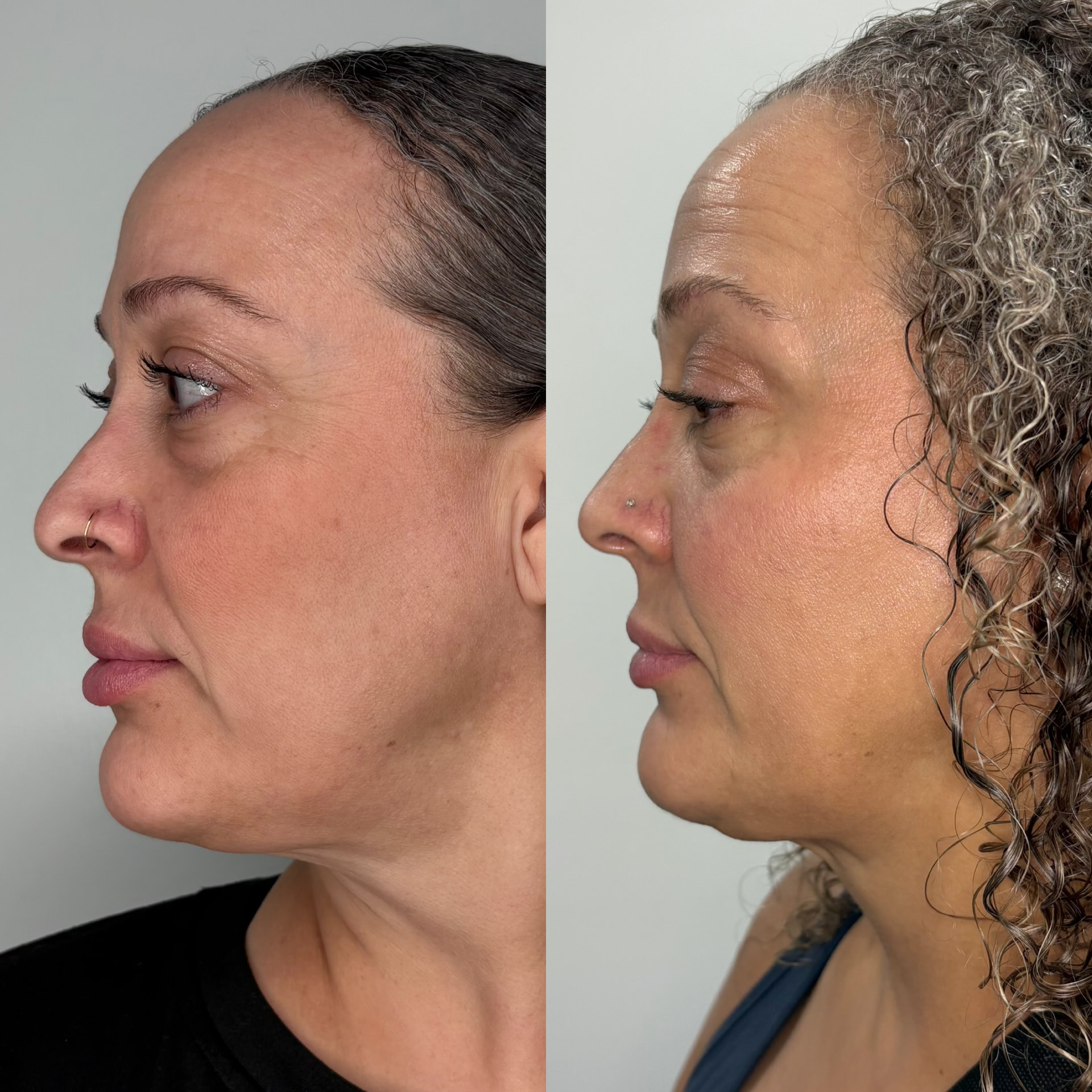 Chin Liposuction and EndoLift combination patient result — before (left) and after (right)