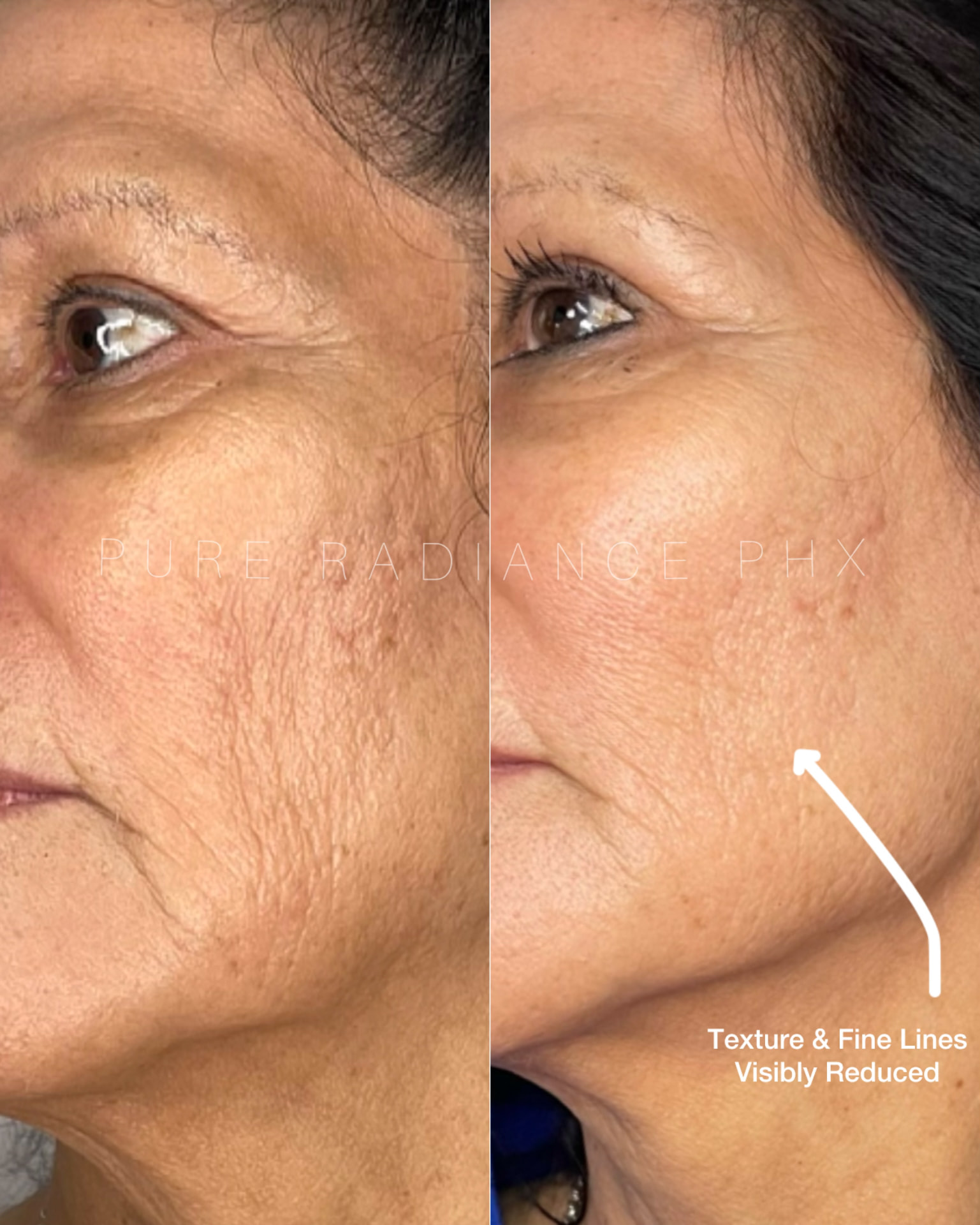 EndoLift patient result — before (left) and after (right)