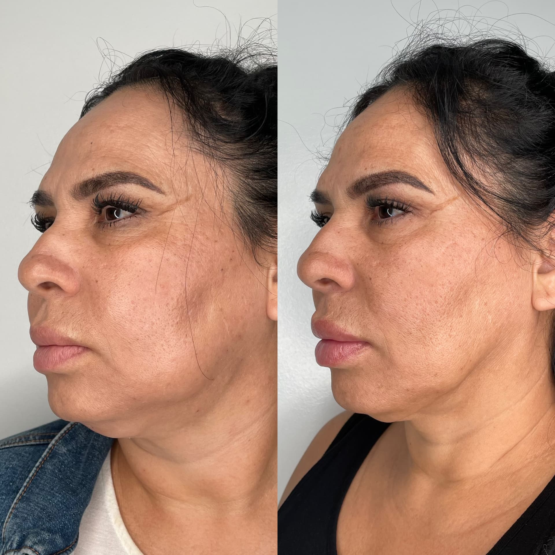 EndoLift patient result — before (left) and after (right)
