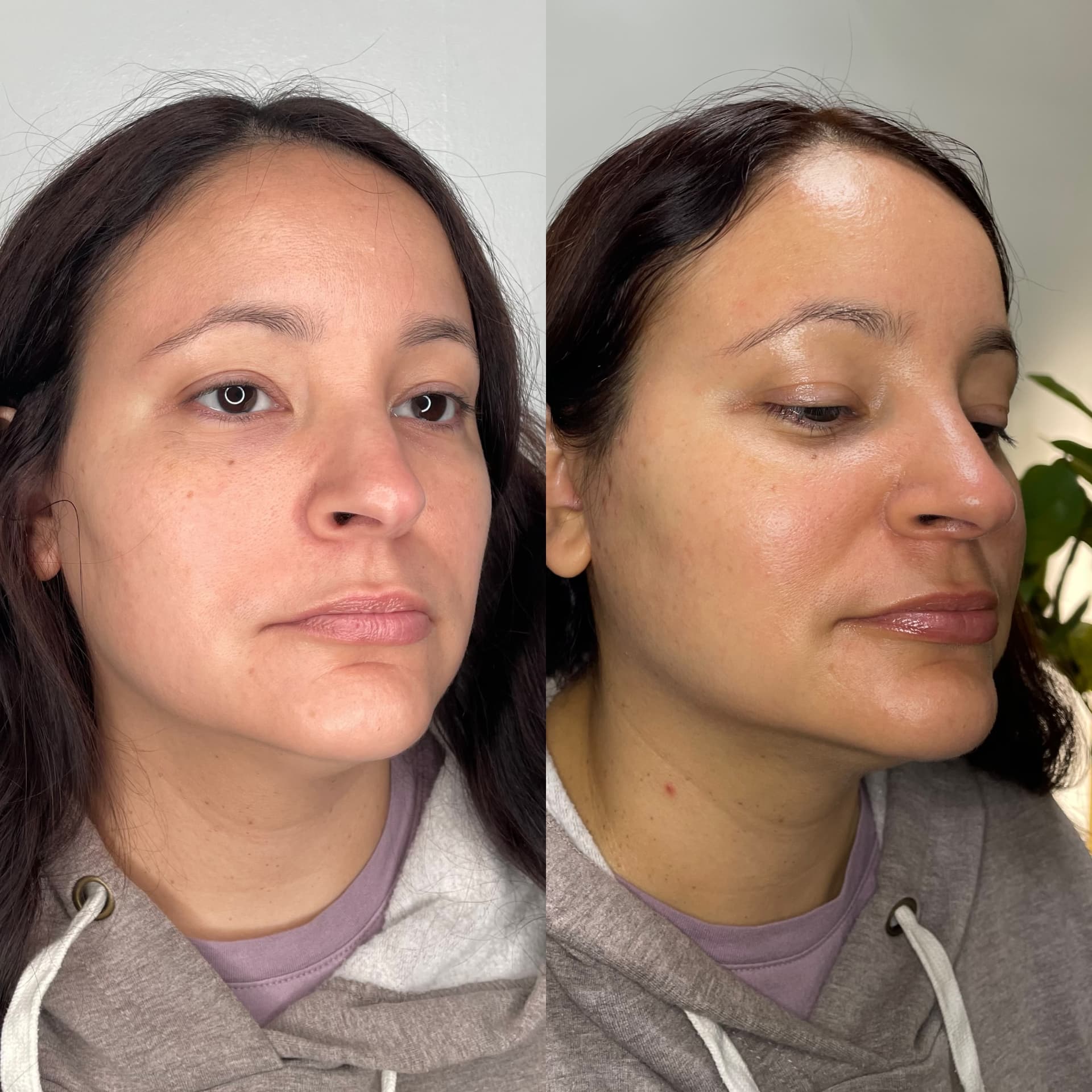 EndoLift patient result — before (left) and after (right)