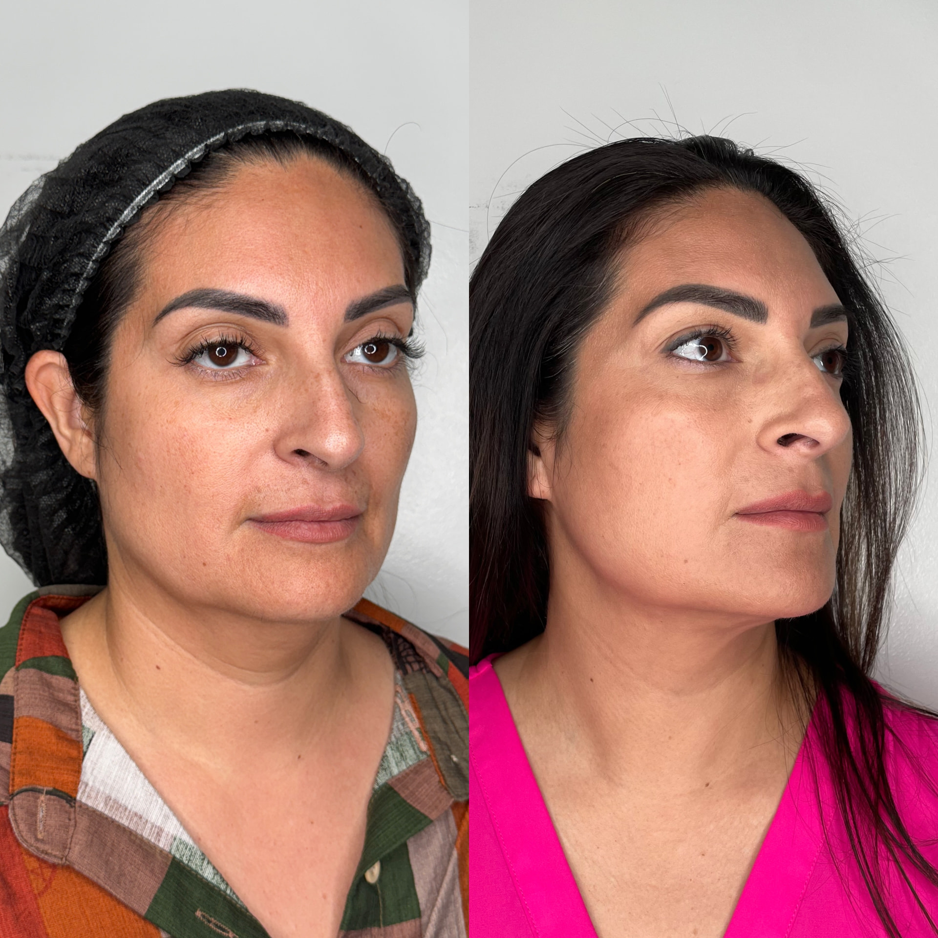 Chin Liposuction patient result — before (left) and after (right)