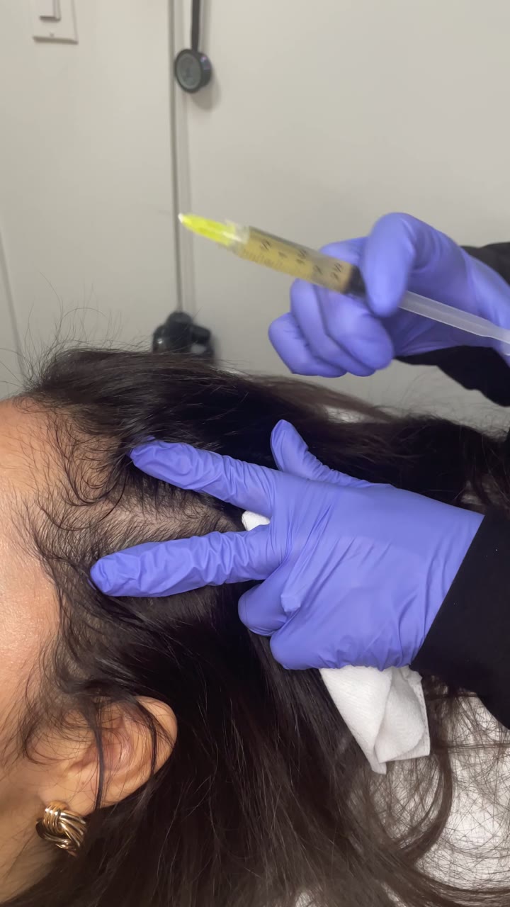 Microneedling treatment at Pure Radiance — clip 7