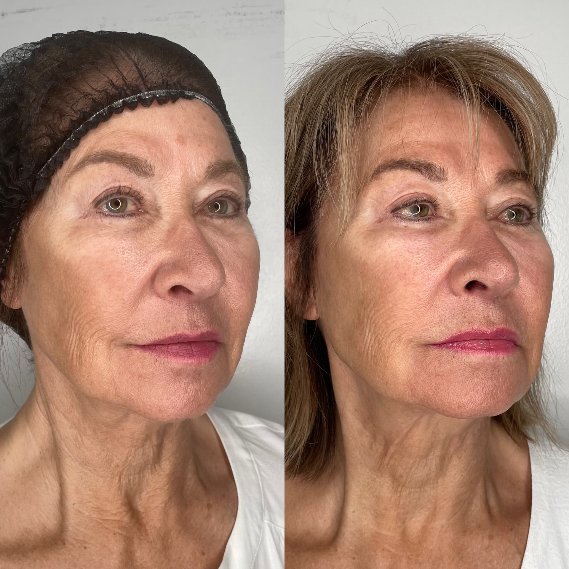 EndoLift patient result — before (left) and after (right)