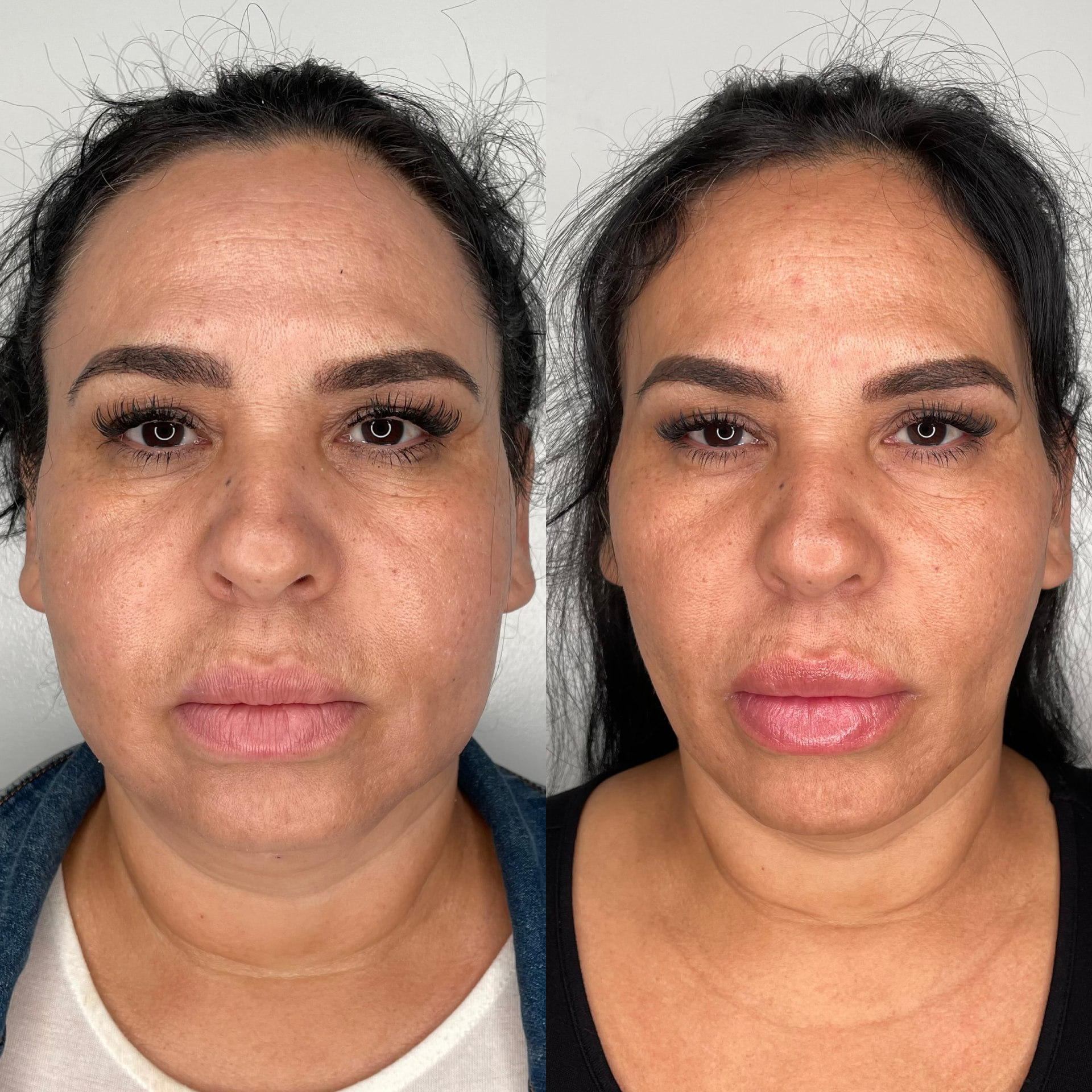 EndoLift patient result — before (left) and after (right)