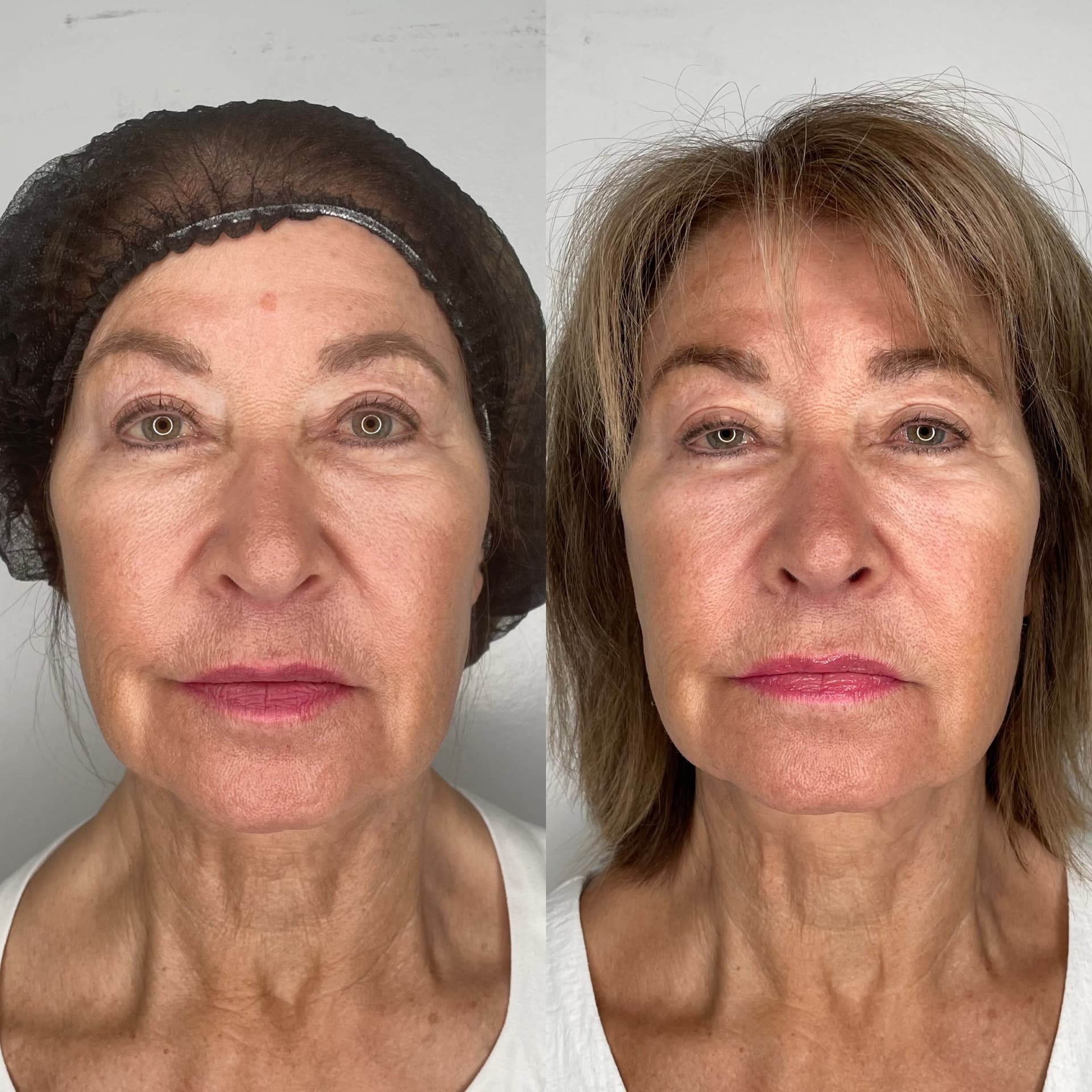 EndoLift patient result — before (left) and after (right)