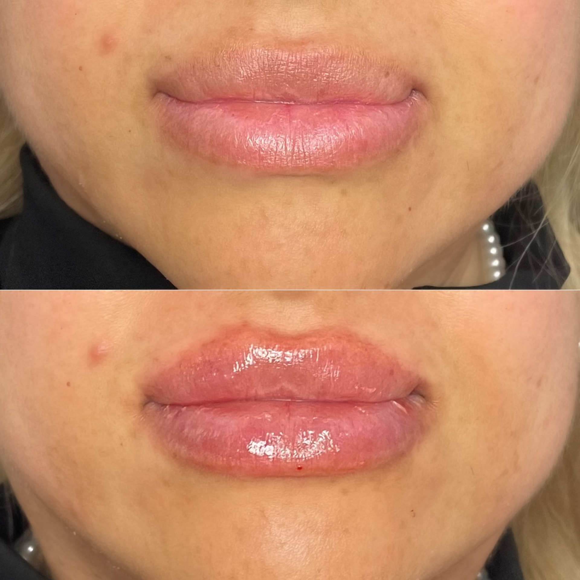 Lip filler patient result — before (top) and after (bottom)