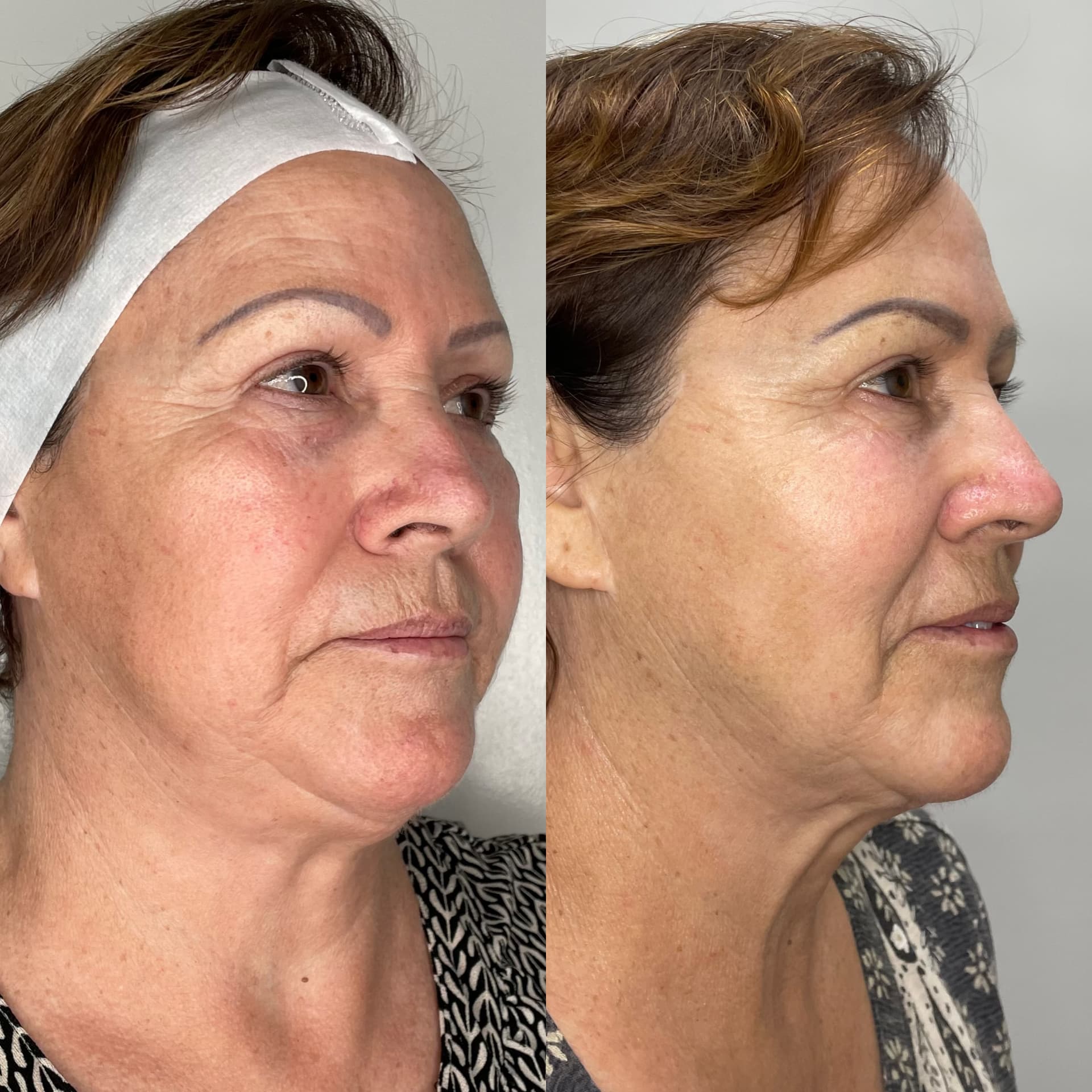 EndoLift patient result — before (left) and after (right)