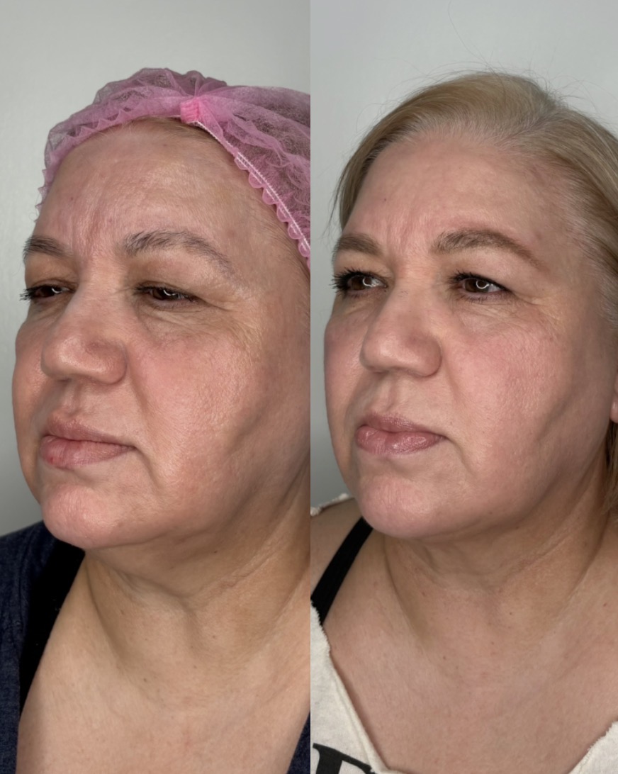 Chin Liposuction and EndoLift combination patient result — before (left) and after (right)
