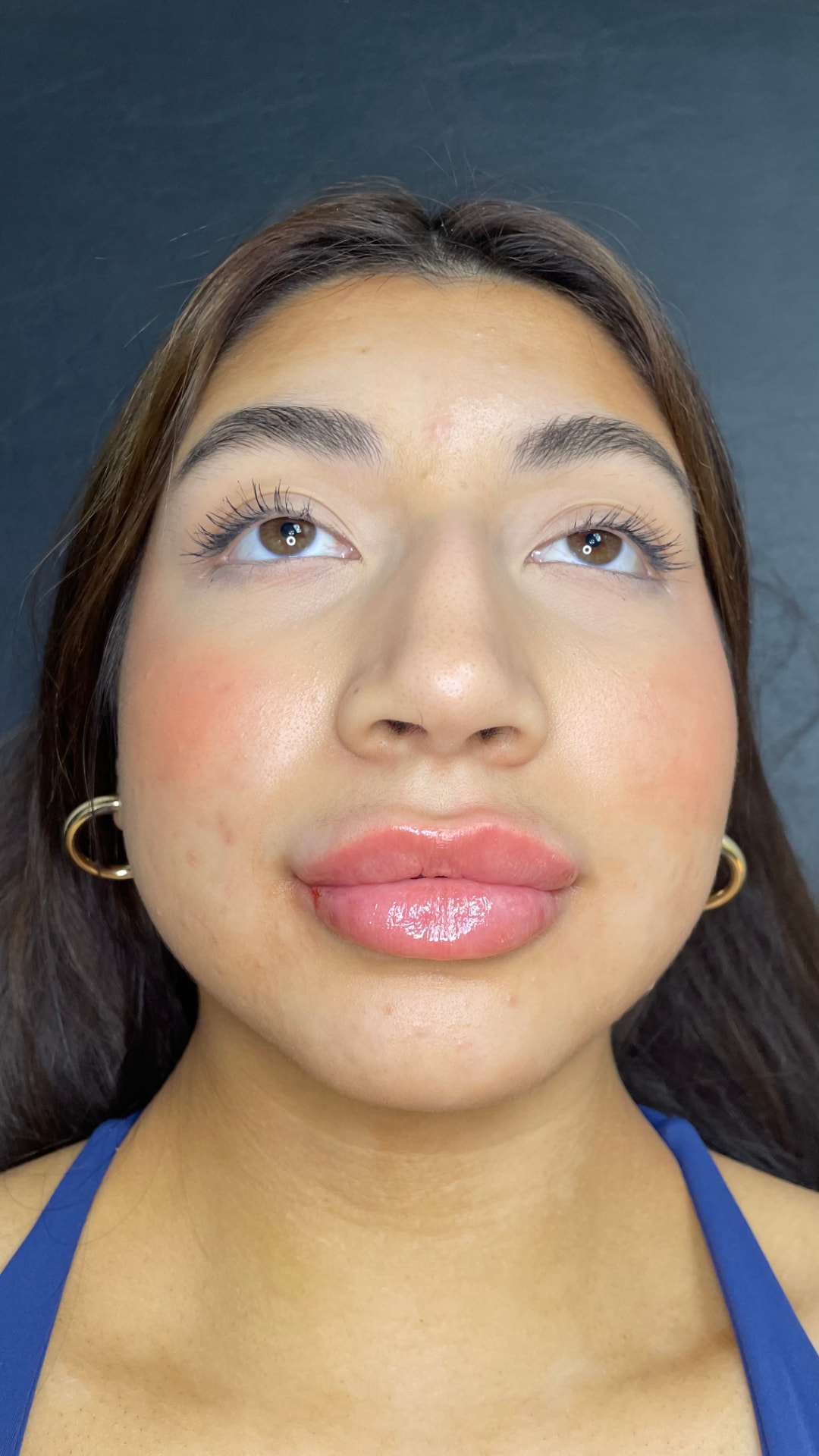 Lip filler patient result — before and after — after