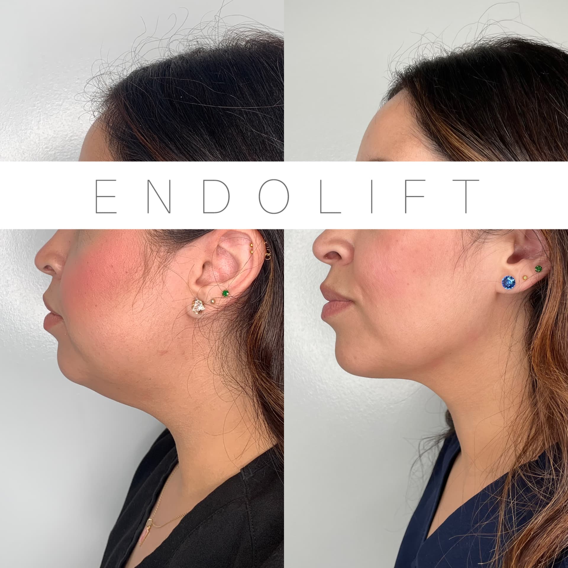 EndoLift patient result — before (left) and after (right)