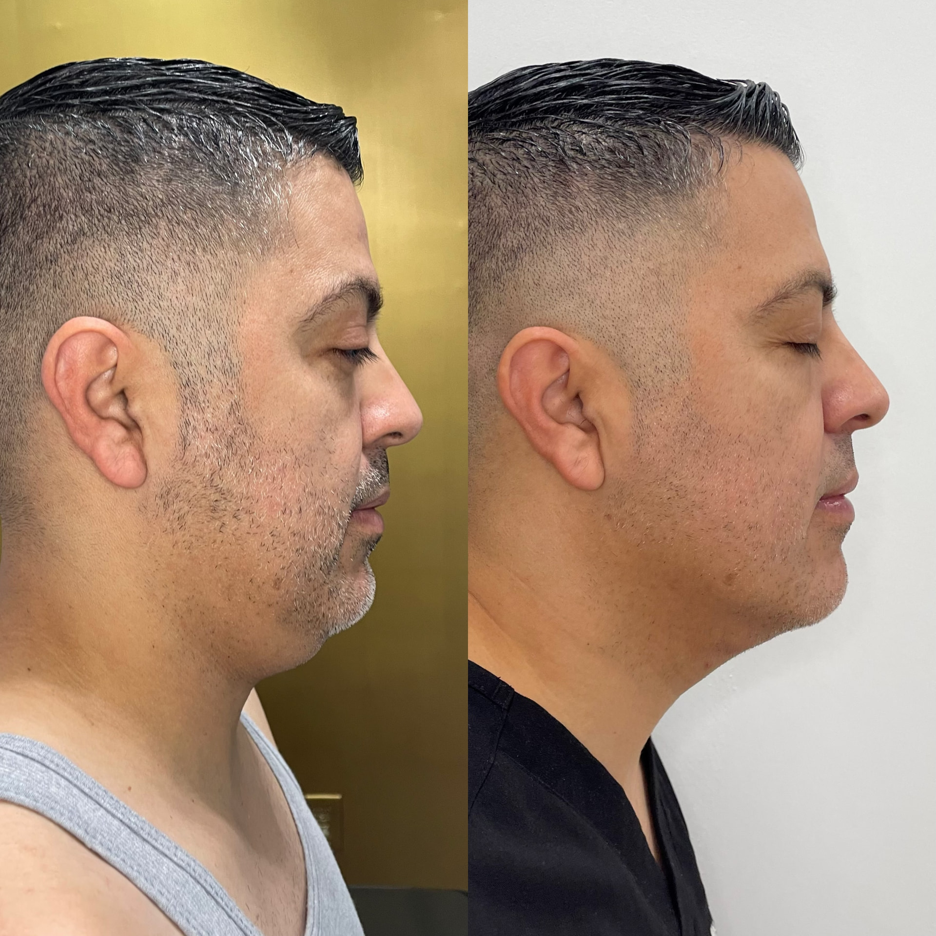 Chin Liposuction patient result — before (left) and after (right)