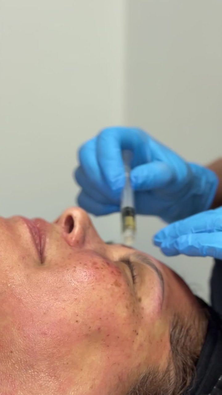 Microneedling treatment at Pure Radiance — clip 8